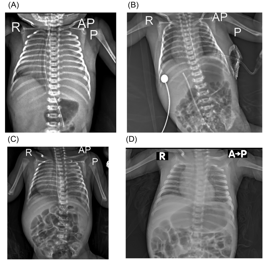 Leite Materno para Sofrimento Respiratório Recorrente Grave em um Bebê Prematuro