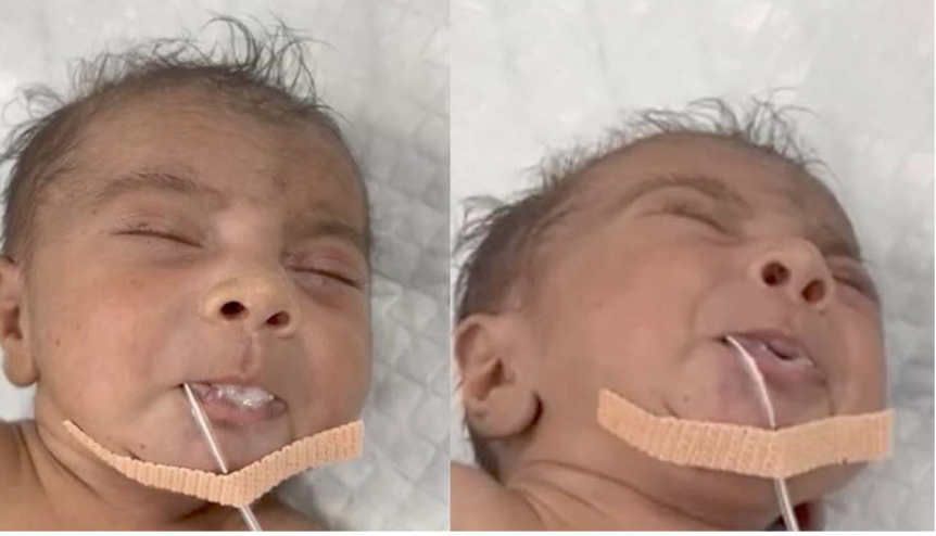 Um Recém-Nascido com Expressão Facial Anormal e Dificuldade de Alimentação