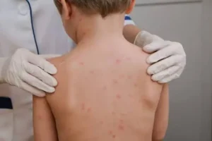 Palestra sobre meningite e meningococcemia no 42º Congresso Brasileiro de Pediatria