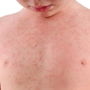 Palestra sobre abordagem da alergia alimentar no 42º Congresso Brasileiro de Pediatria