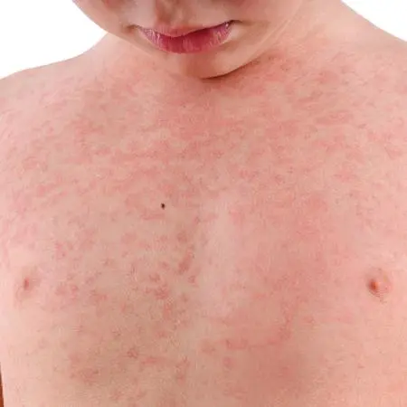 Palestra sobre abordagem da alergia alimentar no 42º Congresso Brasileiro de Pediatria
