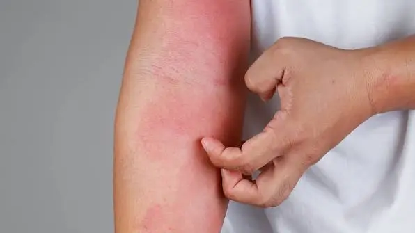 Palestra sobre alergia alimentar e dermatite atópica no 42º Congresso Brasileiro de Pediatria