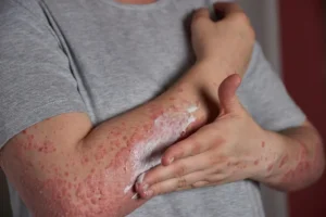Conferência sobre tratamento da dermatite atópica no 42º Congresso Brasileiro de Pediatria