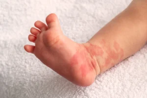 Palestra sobre hemangioma infantil no 42º Congresso Brasileiro de Pediatria