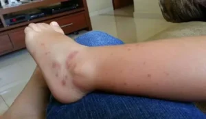 Infográfico ou representação ilustrativa de acompanhamento nefrológico em vasculite por IgA com nefrite.