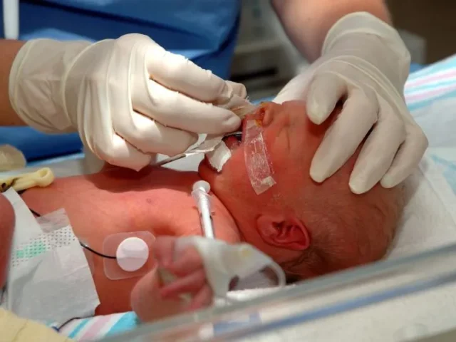 Equipe multiprofissional realizando reanimação neonatal e ventilação com pressão positiva em recém-nascido em sala de parto