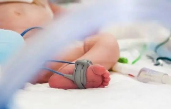 Gráfico de linhas demonstrando limiares de fototerapia e exsanguinotransfusão para hiperbilirrubinemia em prematuros por idade cronológica em horas.